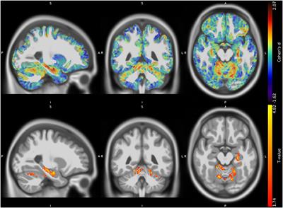 Brain Plasticity in Charcot-Marie-Tooth Type 1A Patients? A Combined Structural and Diffusion MRI Study
